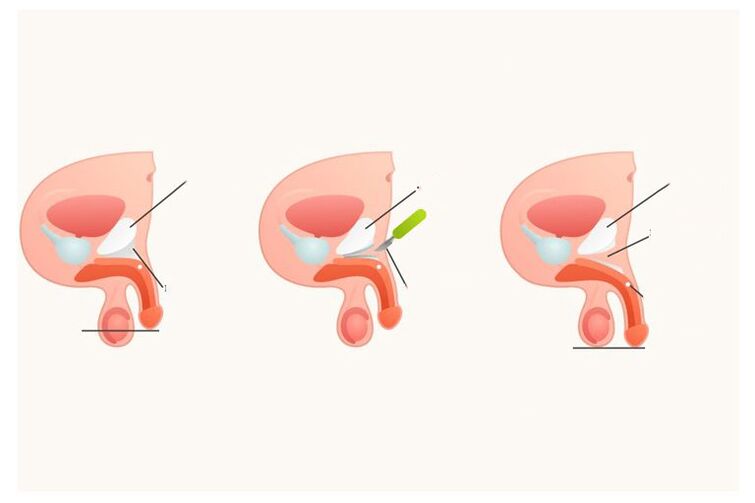 How is penis enlargement surgery performed
